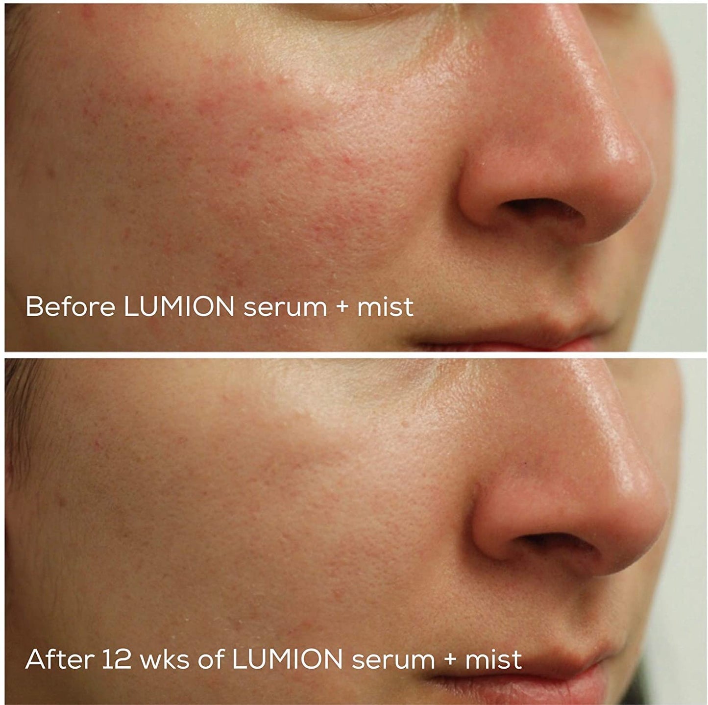 LUMION skin - Natural Miracle Mist Face Spray | Soothes Redness + Irritation, Promotes Healthy, Calm, Clear Skin, Hypochlorous Acid (3.4 fl oz | 100 ml)