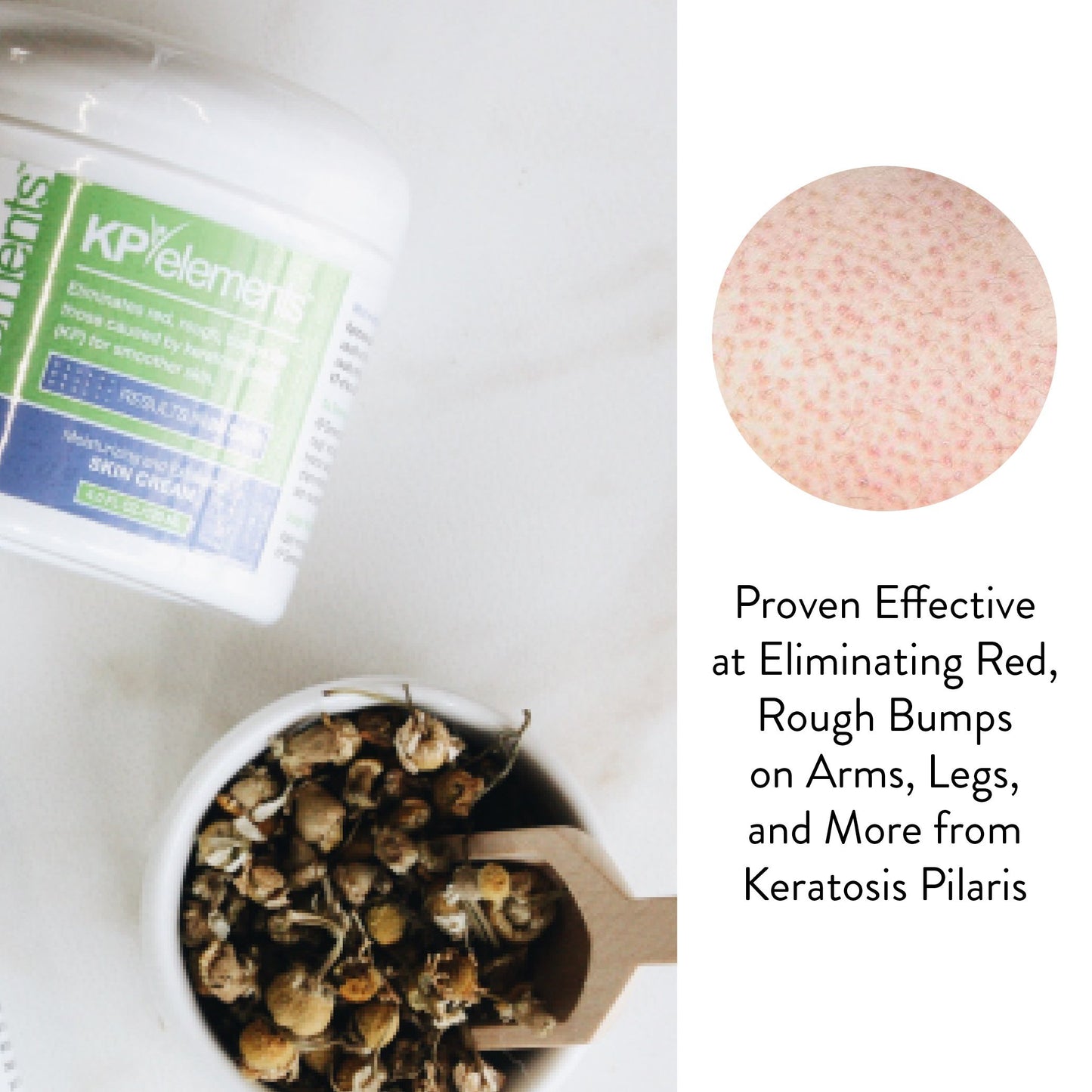 KP Elements Keratosis Pilaris Lotion (4 fl oz) - Natural Keratosis Pilaris Treatment, Moisturizing & Exfoliating AHA Lotion for KP, Vegan, Made in USA