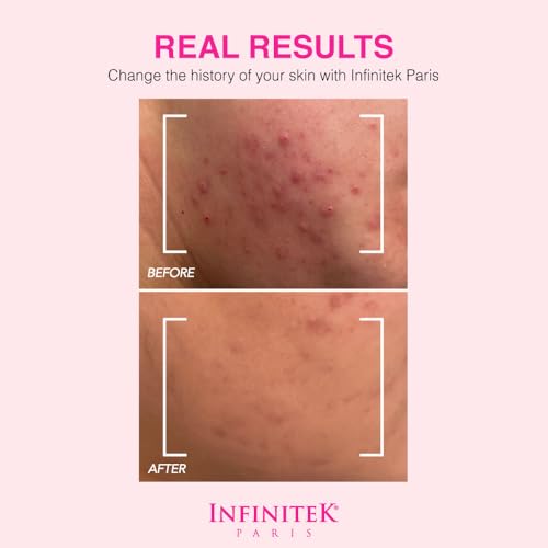 Infinitek Paris | Dead Sea Mud Mask | Galentine¡¯s Gifts & Valentine¡¯s Day Gifts for Women | Face Mask for Acne Treatment, Blackhead Remover, Antioxidant Pore Cleaner | 2.47 oz / 70 g