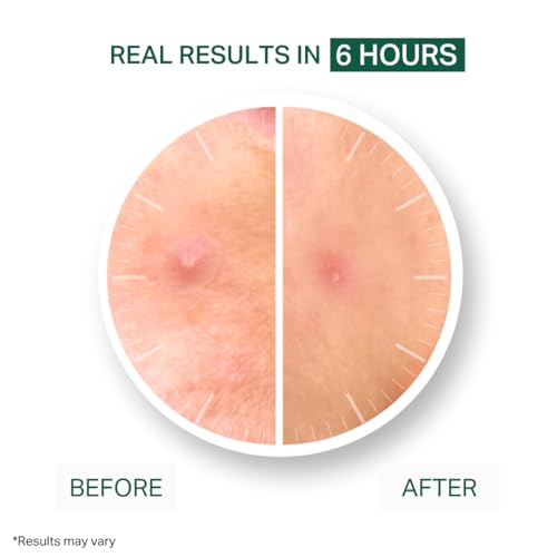 Y¡¯OUR Improving Acne Patches: Ultra-thin Hydrocolloid Healing Pimple Patch for Face; Purifies & Alleviates Stubborn Blemishes, Effective Zit Treatment. 56 Count. Gifts for Her