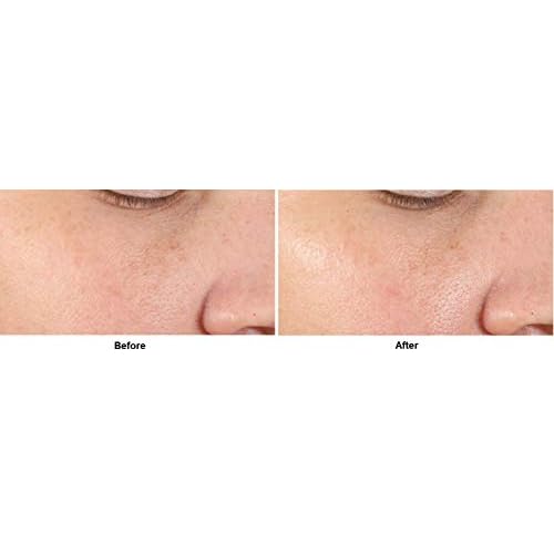 Dr. Dennis Gross Alpha Beta¢ç Pore Perfecting & Refining Serum: for Enlarged, Clogged Pores with Excessive Oil, 1.0 fl oz