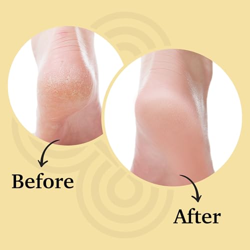 ORBE Derma Solutions Orbe It! 2-Step Acne Treatment ? Clears, Treats & Prevents Acne & Helps Unclog Pores with 2% Salicylic Acid ? Includes Cleansing Spray 1 oz & Treatment Cream 1 oz
