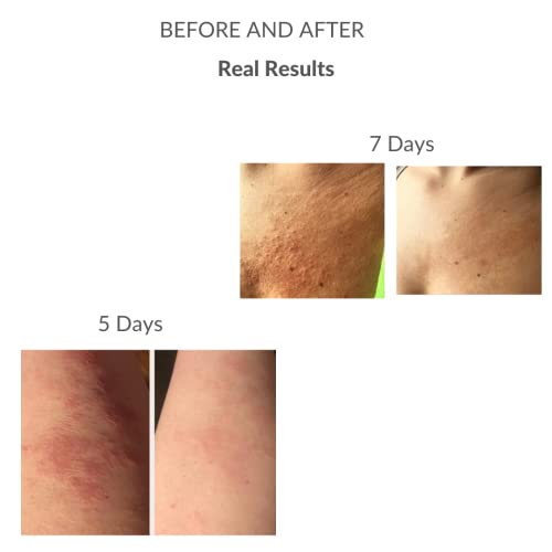 Recovery Cream - PH BALANCE SKINCARE Eczema Cream - Itchy Skin Relief Lotion Treatment For Burns Dermatitis Psoriasis - All Natural No Fragrance Cruelty Oil & Paraben Free 2oz