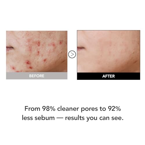 15.5% Panthenol & Cica Exosome | 98% Pore Impurity Cleansing Support | AHA BHA PHA Gentle Exfoliating Wash | Non-Comedogenic | Korean Skincare Cleansing Foam (120ml/4.06 fl.oz.)