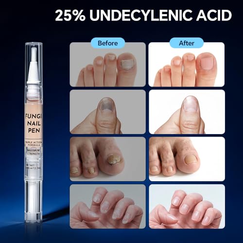 Toenail Fungus Treatment Extra Strength - with 25% Undecylenic Acid - Effective Nail Repair for Damaged Nails, Ingrown Nails & Discoloration - 4-Pack Twist Pen