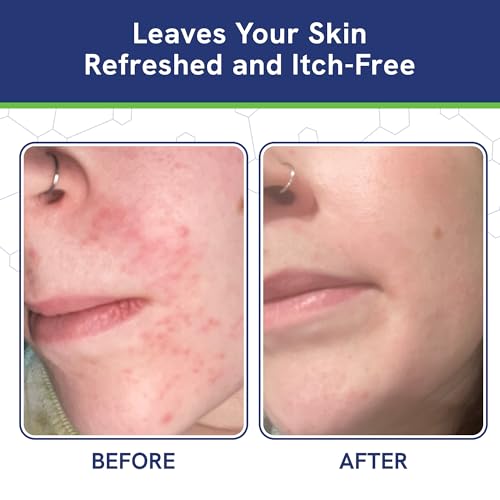 pHat 5.5 Seborrheic dermatitis Moisturizing Cream & Face Lotion for Women - Soothing Redness for Face & Body Cream - Hydrating Face Cream for Dry Skin & Anti Itch Lotion (2oz)