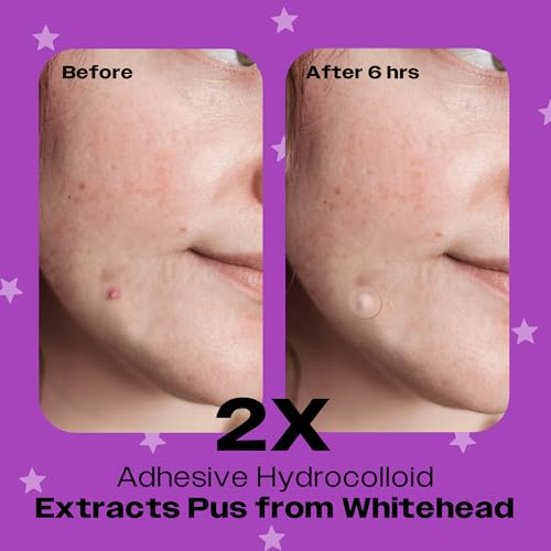 AVARELLE Nighttime Acne Relief/Essentials (Value Pack) Pimple Patches | Hydrocolloid Acne Patches for Blemishes and Zit for Face, Vegan, Cruelty Free
