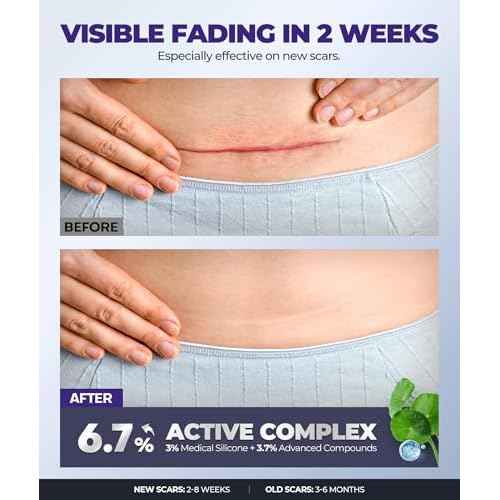 Silicone Scar Cream with 6.7% Active Ingredients, Scar Gel Visible in 2 Weeks, Moisturizing Scar Removal Clinically Show for Surgical, C-Section, Keloid, Acne & Burn Scars, Stretch Mark Cream(55ML)
