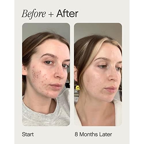 Topicals Post-Acne Kit - Mini Faded Serum for Dark Spots (0.5 Fl Oz) and Sealed Active Scar Filling Primer Retinol and Salicylic Acid for Acne Prone Skin (1 Fl Oz)