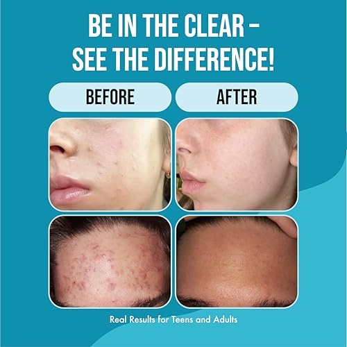 Teenology Face Moisturizer for Teens, Avoid Acne Breakouts, Sulfate & Paraben Free, with Natural Botanical Extracts - Daily Skin Care Cream for Clear & Healthy Skin, 4 oz - (Fragrance Free)