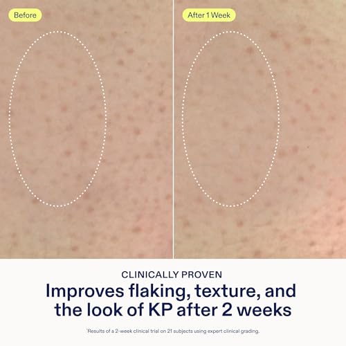 Skinfix KP + PsO Smoothing Body Treatment - 5.07 oz - Clinical-Grade Lactic Acid Smoothing Treatment for Keratosis Pilaris- and Psoriasis-Prone Skin - Safe for Sensitive Skin - Vegan, Cruelty Free