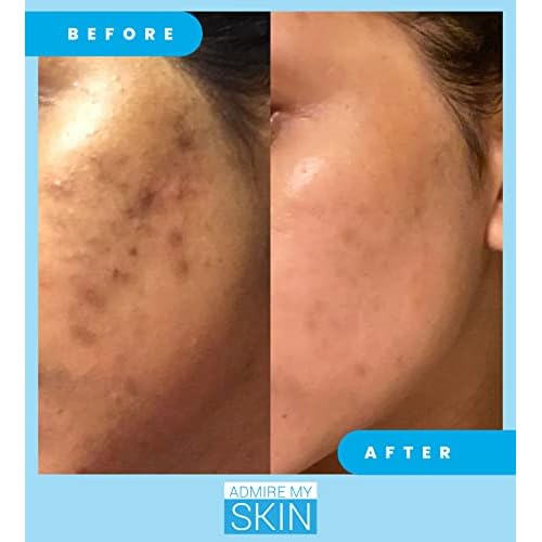 Admire My Skin Dark Spot Remover + Retinoid Cream + Vitamin C Oil