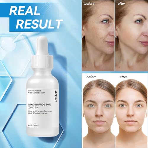 Niacinamide 10% + Zinc 1% Serum for Face ? Oil Control, Acne, Pore Minimizer & Blemish Reduction ? Lightweight, Non-Greasy Facial Serum, 30ml (1 Fl Oz) (1)