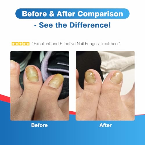 Toenail Fungus Treatment Extra Strength - DR.RAPID Toenail Fungus Treatment Pen with 25% Undecylenic Acid & Tolnaftate, Ideal for Nail Repair for Damaged Nails Toenail Fungus 5ml/0.18FLOZ 3Pcs