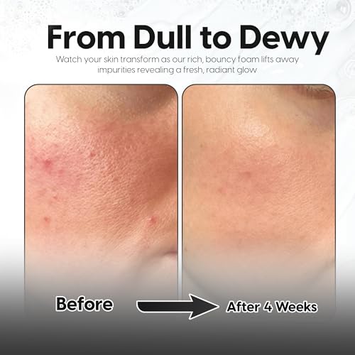 2% Salicylic Acid + 5% Lactic Acid Face & Body Wash ? Breakouts, Keratosis Pilaris, Ingrown Hairs, Psoriasis &Minimizes Pores- Gentle AHA/BHA Exfoliating Cleanser With Ceramides -200ml.