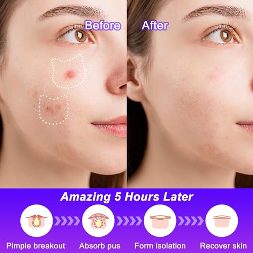 Cat Pimple Patches,Cute Pimple Patches,Acne Patches for Face, Cute Stickers,Salicylic Acid & Tea Tree, 120 Hydrocolloid Dots in 20 Colors for Face,Cute Cat Pimple Stickers