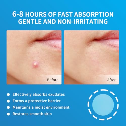 Pimple Patches for Face Hydrocolloid Acne Patches, Invisible Zit Stickers Covering Blemishes, 3 Size Hydrocolloid Spot Stickers for Face and Skin (144 Count(Pack of 1))