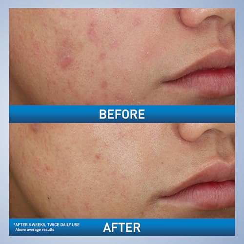 CeraVe Acne Foaming Cream Wash, Gentle Face and Body Cleanser with Benzoyl Peroxide 10%, Hyaluronic Acid, and Niacinamide, 10% Benzoyl Peroxide Treatment Clears Pimples and Blackheads 5 Oz