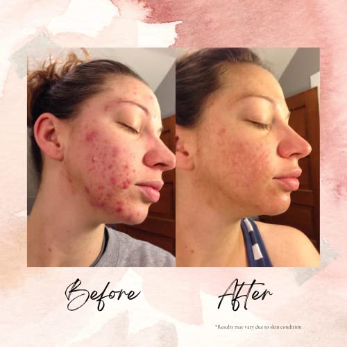 LEROSETT Spot Treatment Clay Mask & Moisture Matte¢â Bundle