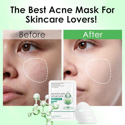 IREV Face Masks Skincare, Salicylic Acid Facial Mask, Moisturizing Sheet Mask For Acne Prone,Oily, and Sensitive Skin, Deep Cleansing Mask 10 Sheets