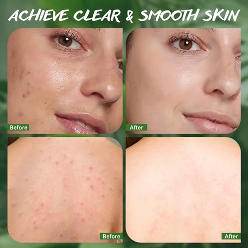 Perilla T?a T? Soap Bar, Soap For Face and Body, Back Acne Body Soap, Anti-Acne Cleansing Healthy Skin, Mosquito Repellent Soap, Soap for Men, Women, Teen and All Skin Types