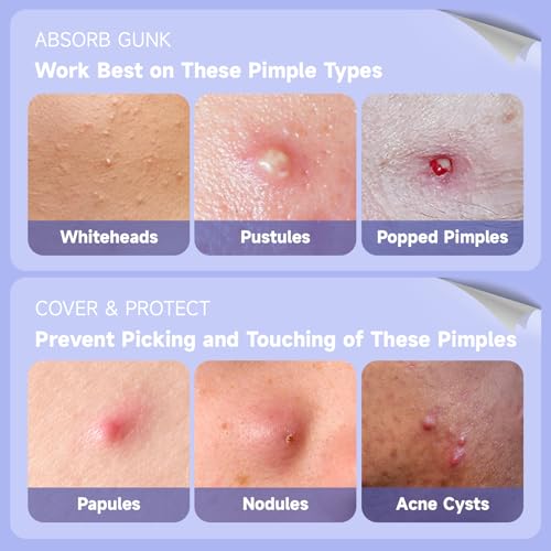 Ultra Pimple Patch Variety Pack Hydrocolloid Pimple Patches with Salicylic Acid for Covering Small & Large Zits and Blemishes, Spot Stickers for Face and Skin (36 Counts)