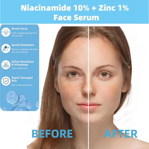 Niacinamide 10% + Zinc 1% Serum for Face ? Oil Control, Acne, Pore Minimizer & Blemish Reduction ? Lightweight, Non-Greasy Facial Serum, 30ml (1 Fl Oz) (1)