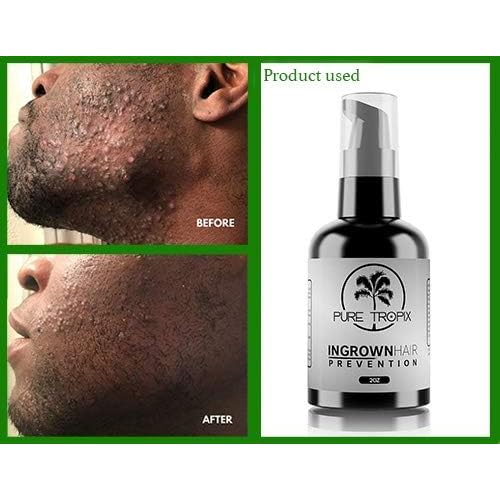Pure Tropix Ingrown Hair Treatment & Prevention Kit - Razor Bump and Burn Remover - Bikini Lines & Acne - Use After Shaving, Hair Removal, Waxing, Laser, Electrolysis - for Men and Women (59ml)