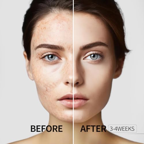 HANYWIL Dark Spot Remover for Face and Body, Dark Spot Corrector Serum, Age Spot Sun Spot Freckles Brown Spot Remover, Melasma Treatment for Face, Skin Care Serum with Roller