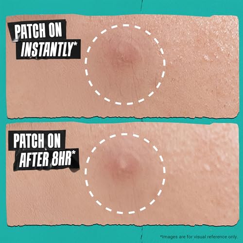 Kiehl's Overnight Pimple Patches - Truly Targeted Invisible Hydrocolloid Blemish Patch, Absorbs Oil and Gunk, Treatment for Whiteheads and Zits, Shrinks Breakouts (22 Count)
