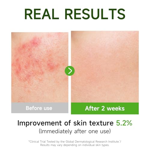 Centella Asiatica Serum Centella Tea Tree Ampoule Facial Serum Korean Centella Serum for Acne-Prone Oil Skin Soothing, Calming, Reduce Redness 105ml