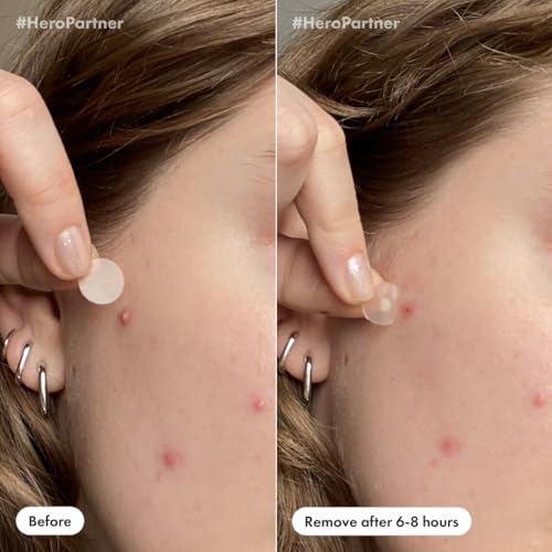 Mighty Patch¢â Day and Night Patches ? The Hydrocolloid Patch Duo Pack. Derm-Tested. Medical-Grade Hydrocolloid. Absorbs Pimple Gunk in 6-8 Hours. 36ct (18x Original, 18x Invisible+)