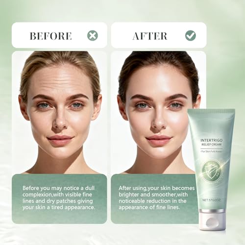 New Intertrigo Cream,Professional Intertrigo Relief Cream, Skin Fold Care & Chafing Support Cream With Zinc Oxide & Undecylenic Acid Helps Soothe Irritated Skin, Moisture & Friction Control (2PCS)
