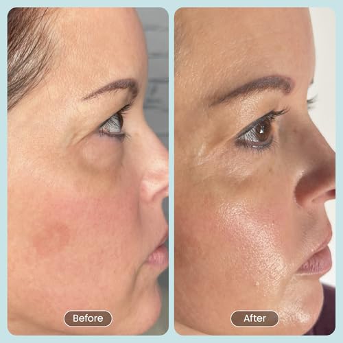 30 DAY MIRACLE BHA 20% Peeling Solution - Clinical Strength BHA Liquid Exfoliant for Clogged Pores, Wrinkles & Blackhead Remover - Salicylic Acid Serum & Chemical Exfoliant for Face Peel 1oz