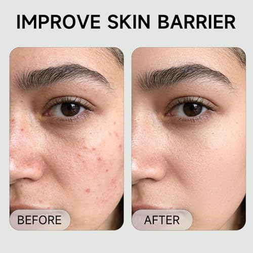 2% BHA Salicylic Acid Liquid Exfoliant Serum For Blackhead Removal,Unclog Pores,Smooths skin118mL 4 fl OZ Face Exfoliator For Facial Skin Care