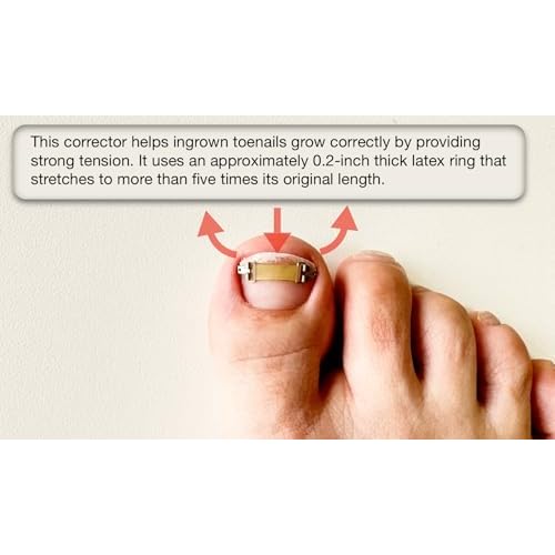 Ingrown Toenail Treatment & Corrector with Latex Elasticity - Curved Toenail Straightener | Effective Daily Solution for Ingrown Toenail Pain & Growth Correction [S/0.67inches/16-18mm]