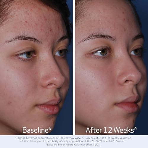 Obagi CLENZIderm M.D. Daily Care Foaming Acne Cleanser ? Acne Treatment with 2% Salicylic Acid (BHA)