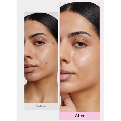 EasyDerm 4-Type Acne Patches Variety Set and 2-in-1 Pimple Popper Tool