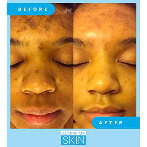 Admire My Skin Dark Spot Remover + Retinoid Cream + Vitamin C Oil