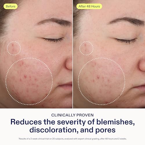 Skinfix 2% BHA Cleanser - 1 oz - Clears Acne Blemishes & Blackheads - Safe for All Types of Acne - Fragrance Free - Vegan, Cruelty Free