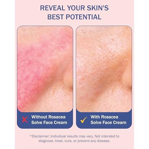 Rosacea Treatment Skincare Face Wash for Women & Men - Gentle Face Cleanser Moisturizer Redness Reducing Skin Care with Aloe Vera, Hyaluronic Acid & Fruit Extracts, Made in USA (8 fl. oz)
