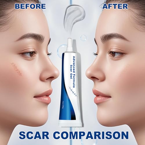 Advance Scar Gel, Scar Cream, Advanced Formula Scar Gel for Old & New Scars, Surgical Scars, Face, Body, Leg, Burns, Acene, C-Section, Stretch Marks, Keloids, Scar Removal for Adults & Kids