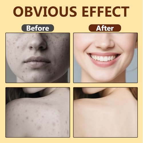 Bee Venom Cream, Natural Bee Venom Skin Treatment Cream-for Removing and Repair, Effective In Reducing Skin Blemishes, Gentle and Non-irritating(Yellow)
