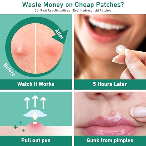 Large Hydrocolloid Pimple Patches for Face, Variety Pack 5 Sizes 196 Count, XL Invisible Acne Spot Dots Stickers for Chin, Nose, Back, Forehead Zits, Blemishes & Breakouts, Tea Tree Oil Salicylic Acid