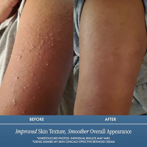 Admire My Skin Potent Retinoid Cream - Anti Aging Retinol Cream Moisturizer to Help Clear Acne Prone Skin, Eliminate Wrinkles and Provide You With That Healthy Youthful Glow
