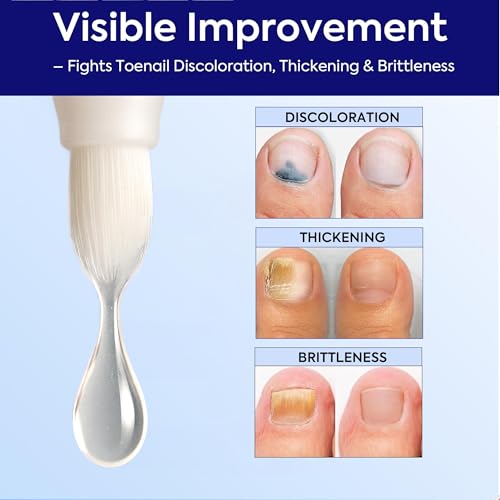 Nail Fungus Treatment Extra Strength: 25% Undecylenic Acid Formula - Toenail Fungus Treatment Kit with 5 Pens & Nail File for Ingrown Nails, Discoloration & Brittle Nails