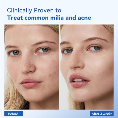Milia Remover for face and eyes: Milia remover treatment with 3% Salicylic Acid for Acne exfoliant, Advanced formula for Men and Women 30ML