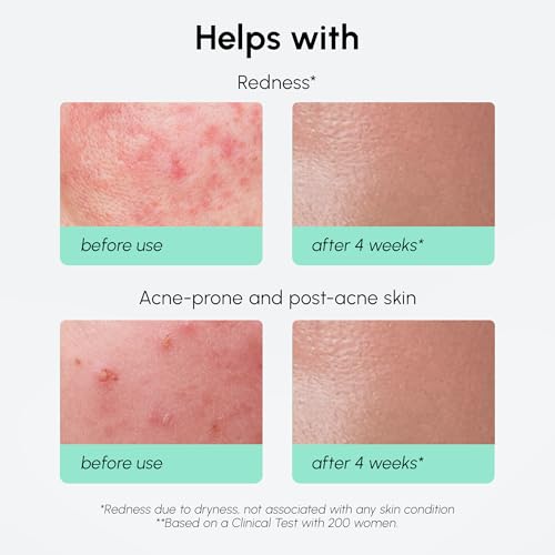 MAREE 10% Azelaic Acid Face Serum - Redness Soothing Hydrating Serum with Niacinamide, Centella Asiatica & Hyaluronic Acid - Relief Serums for Face & Body - Azalecic Acid Skin Facial - Acido Azelaico