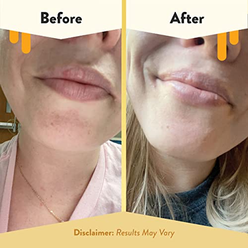 ECZEMA HONEY Nourishing Lip Balm - Organic Chapstick for Sensitive Skin - Daily Lip Moisturizer for Very Dry Lips - Mango Butter & Honey Lip Balm - Natural Lip Care Products (1 Ct) (Pack of 2)