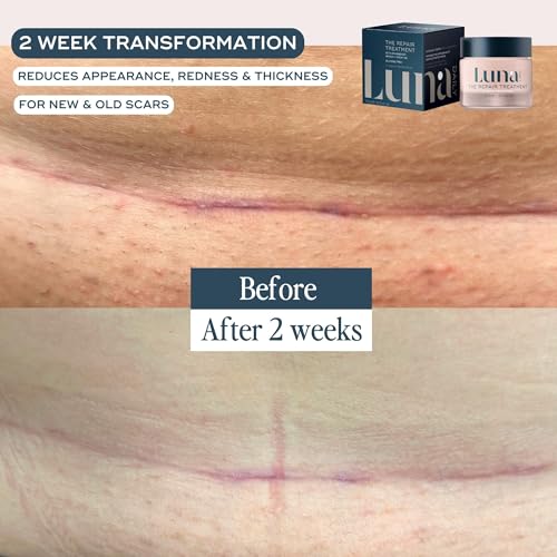 Luna Daily Stretch Mark & Scar Treatment Gel | Daily Repair Moisturizer for Body, Acne & Post-Surgery Scars | With Arnica & Hydrating Actives | Supports Skin Healing, Smoothness & Recovery, 50ml